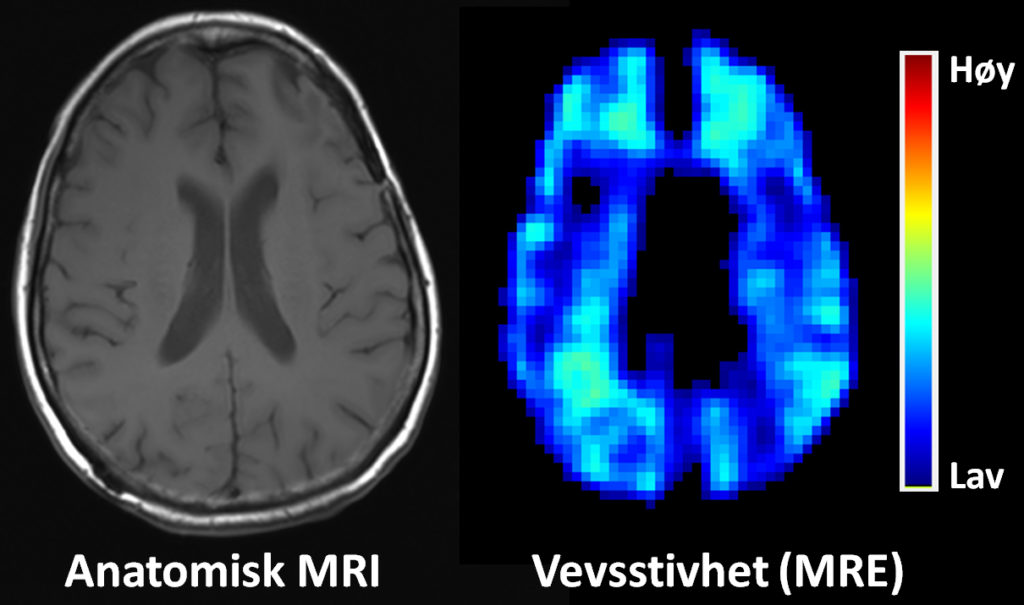 Figur 2: Måling av stivhet i hjernevev ved hjelp av MR Elastografi (MRE). MR-bilder i en frisk frivillig person som viser konvensjonell anatomi (venstre side) og vevsstivhet (høyre side). Ulikt tradisjonelle MR-bilder viser MRE-teknikken funksjonelle mål på de mekaniske kreftene i bløtvevet. Ved å sammenligne MRE med blodstrømsmålinger håper vi å kunne måle redusert perfusjon som følge av tumorvekst. Sammen med økt stivhet i bindevevet kan denne veksten potensielt klemme sammen blodårene i kreftsvulsten og redusere effekten av behandling. Metoden skal valideres opp mot bildeveiledet nevrokirurgi i pasienter med glioblastom.