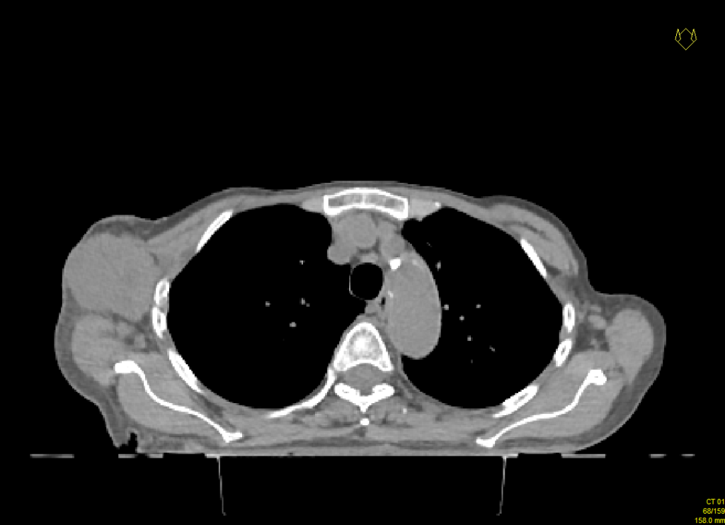 Figur 1: CT: stor patologisk glandel i høyre axille.