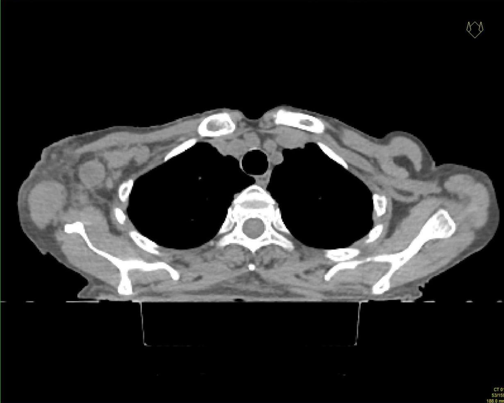 Figur 2: CT: patologiske glandler i axilletoppen og subpectoralt