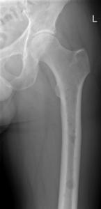 Figur 7: Osteolytiske lesjoner i den proksimale halvdelen av diafysen