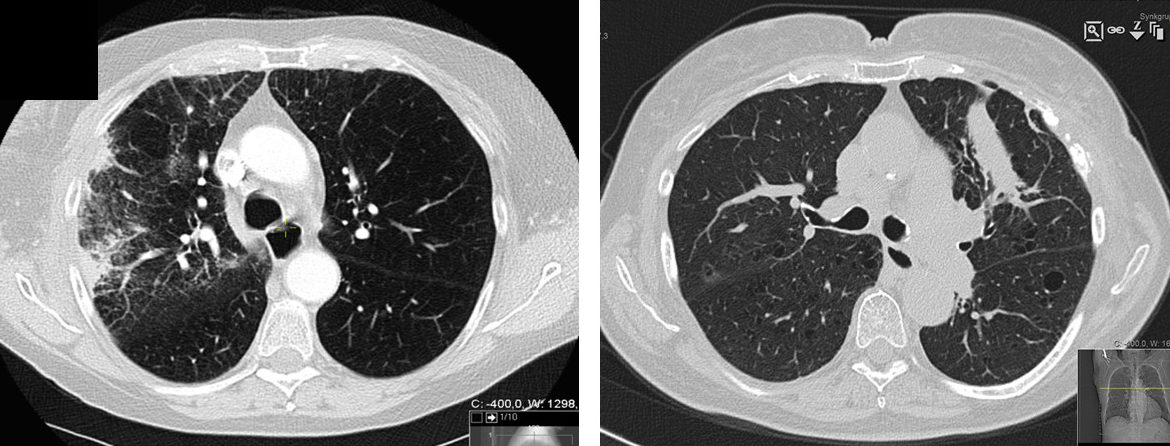 CT-bilder med post-SBRT lungeforandringer