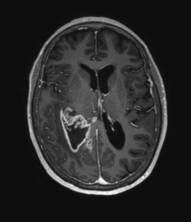 Figur 1. Glioblastom i høyre temporallappsregion. MR-bilde i T1-vektet sekvens med kontrast som viser utseende av et glioblastom med en kontrastladende svulst med sentralt henfall. Copyright forfatterne.