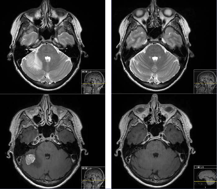 Bilde 3. Hjernemetastase før og 5 måneder etter stereotaktisk strålebehandling. (Avd for radiologi OUS)