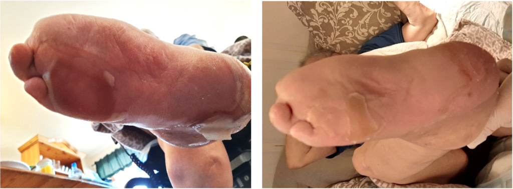 Figur 4: Hånd-fot-syndrom to uker etter oppstart (venstre) og fire uker etter seponering (høyre) av sorafenib (foto tatt av pårørende og publisert med samtykke; amputerte tær skyldes diabetes fra tidligere).