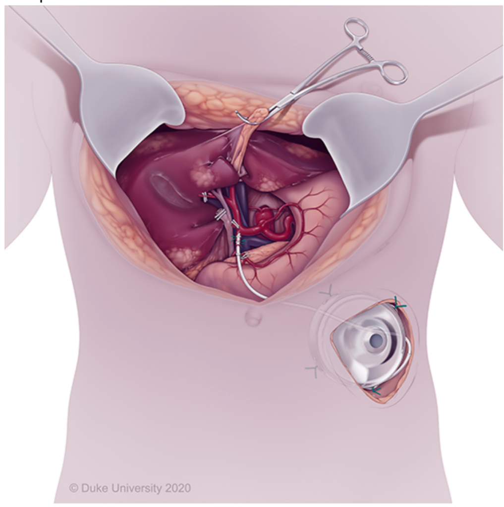 Figur 1: Illustrasjonen viser implantasjon av HAI-pumpe peroperativt hvor pumpen er plassert ­subkutant med kateter til arteria gastroduodenalis. Med ­tillatelse fra [5,6]