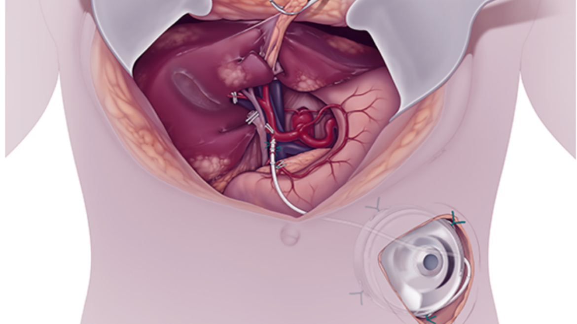 Figur 1: Illustrasjonen viser implantasjon av HAI-pumpe peroperativt hvor pumpen er plassert ­subkutant med kateter til arteria gastroduodenalis. Med ­tillatelse fra [5,6]