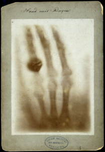 Figur 3. Hånden til Anna Bertha Röntgen f. Ludwig 22.desember 1895(3), tatt ved Fysikklaboratoriet i Würzburg. Den håndskrevne teksten med flertallsformen «Ringen» kan tolkes som at hun hadde 2 ringer på ringfingeren, (trolig venstre hånd).