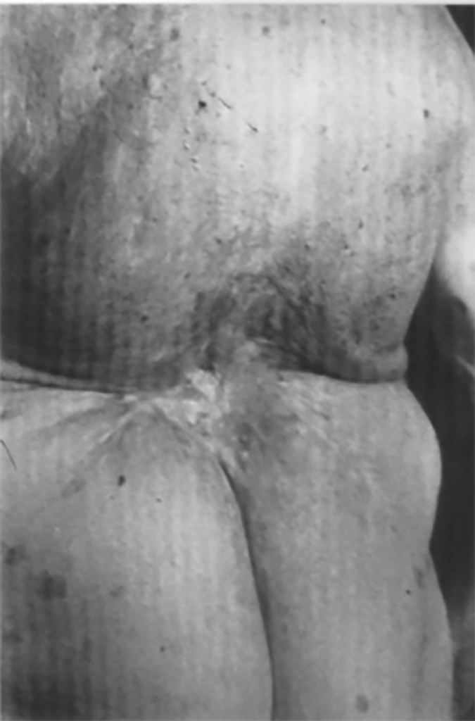 Figur 4C. Seneffekter 75 år etter ­röntgenbehandling (18).