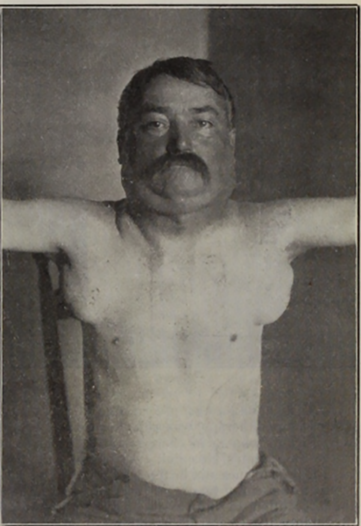 Figur 5B. Foto før röntgenbehandling 1903 av regionalt avansert ­lymfadenopati i axiller og hals. Begynnende Stoke’s krage? 