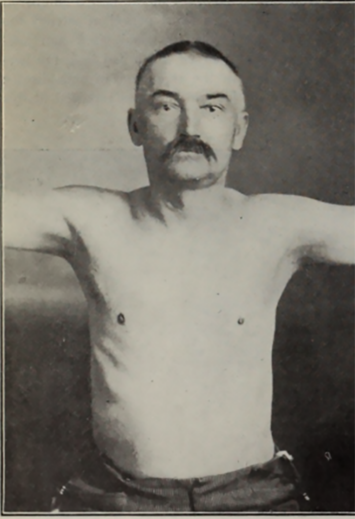 Figur 5C. Etter röntgenbehandling 1903 for antatt regionalt avansert Mb. Hodgkin9, ukjent tidspunkt etter behandling. Tydelig synlig remisjon. Mulig Stoke’s krage ikke lenger til stede. Han var magrere, men barten var i behold.
